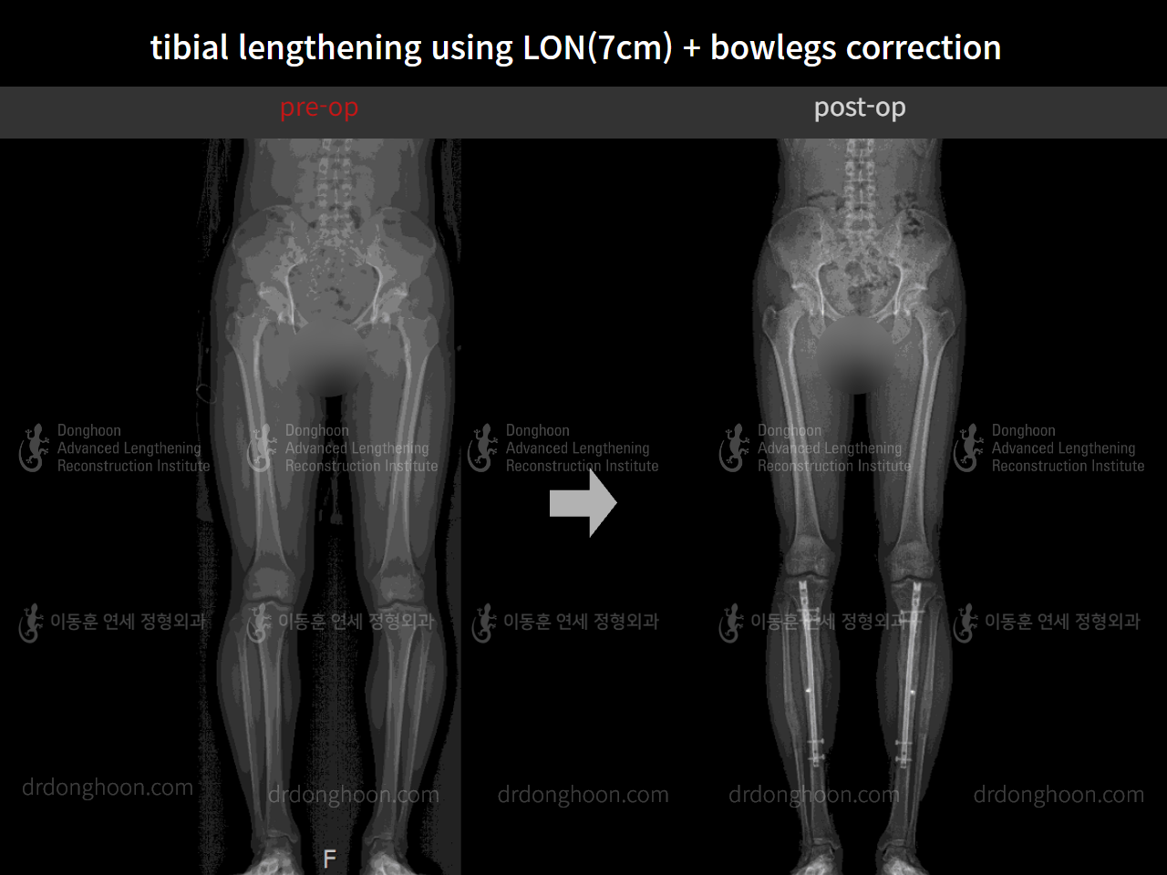 Before and after cll + deformity correction, case 4585644, image 9, Dr. Donghoon institute (DALRI)
