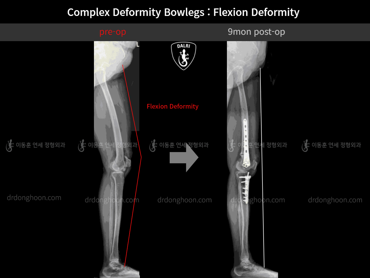 Before and after osteotomy for knee osteoarthritis, case 11337460, image 11, Dr. Donghoon institute (DALRI)