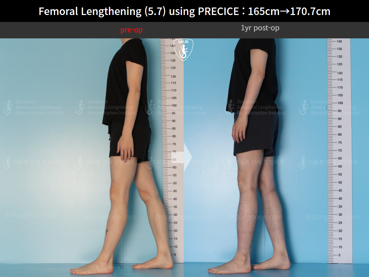 Before and after cll precice, case 15417090, image 5, Dr. Donghoon institute (DALRI)