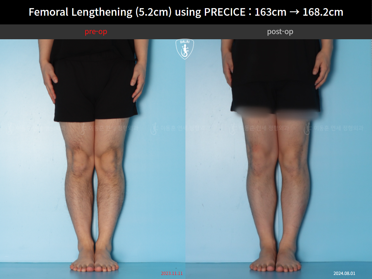 Before and after cll precice, case 55585697, image 7, Dr. Donghoon institute (DALRI)