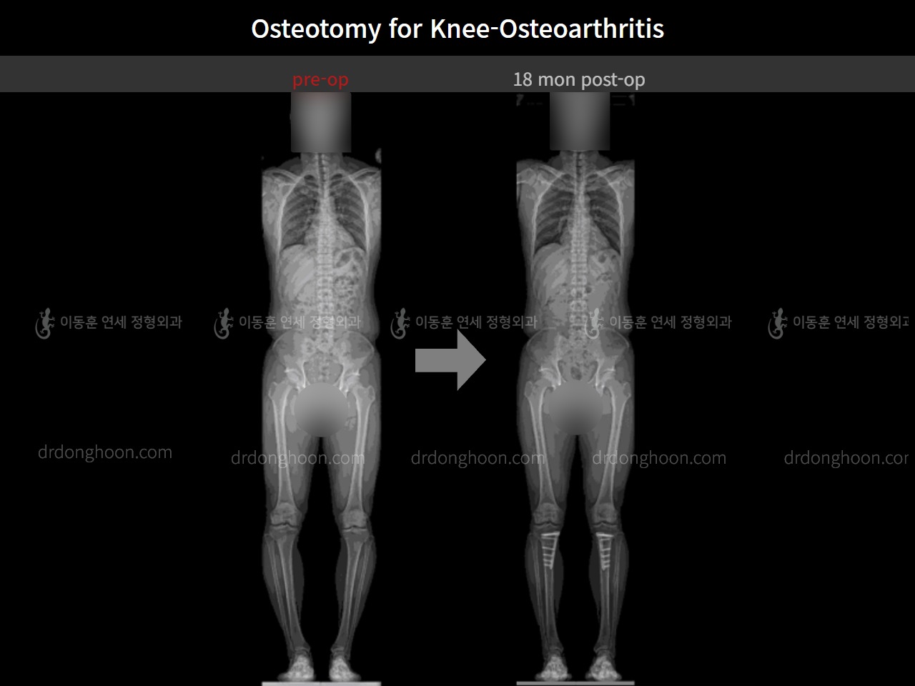 Before and after osteotomy for knee osteoarthritis, case 5394670, image 7, Dr. Donghoon institute (DALRI)