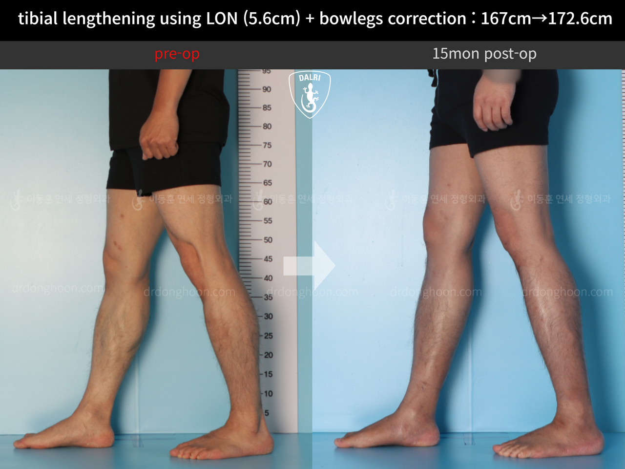Before and after cll + deformity correction, case 12804946, image 7, Dr. Donghoon institute (DALRI)