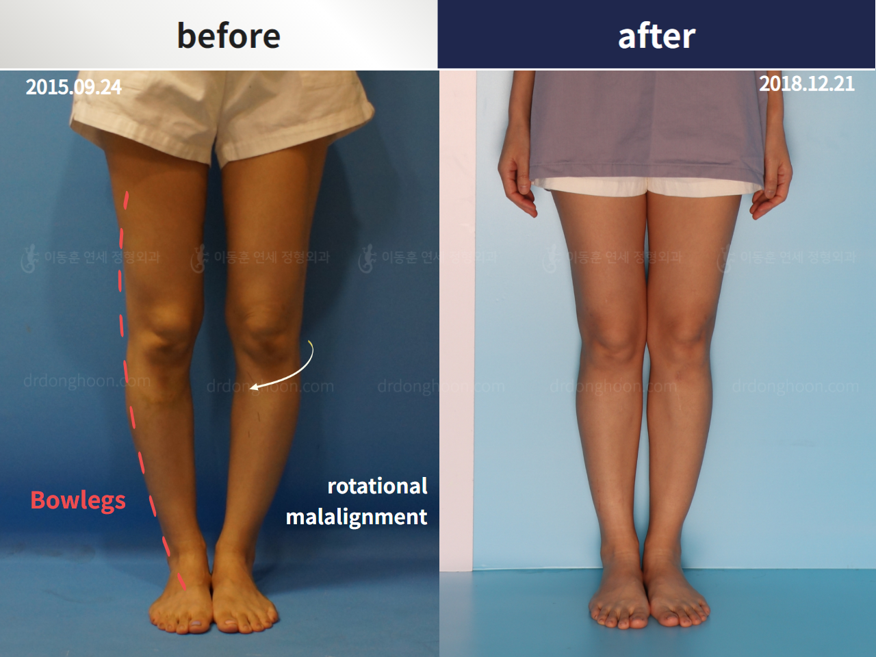 Before and after complex deformity, case 4251622, image 1, Dr. Donghoon institute (DALRI)