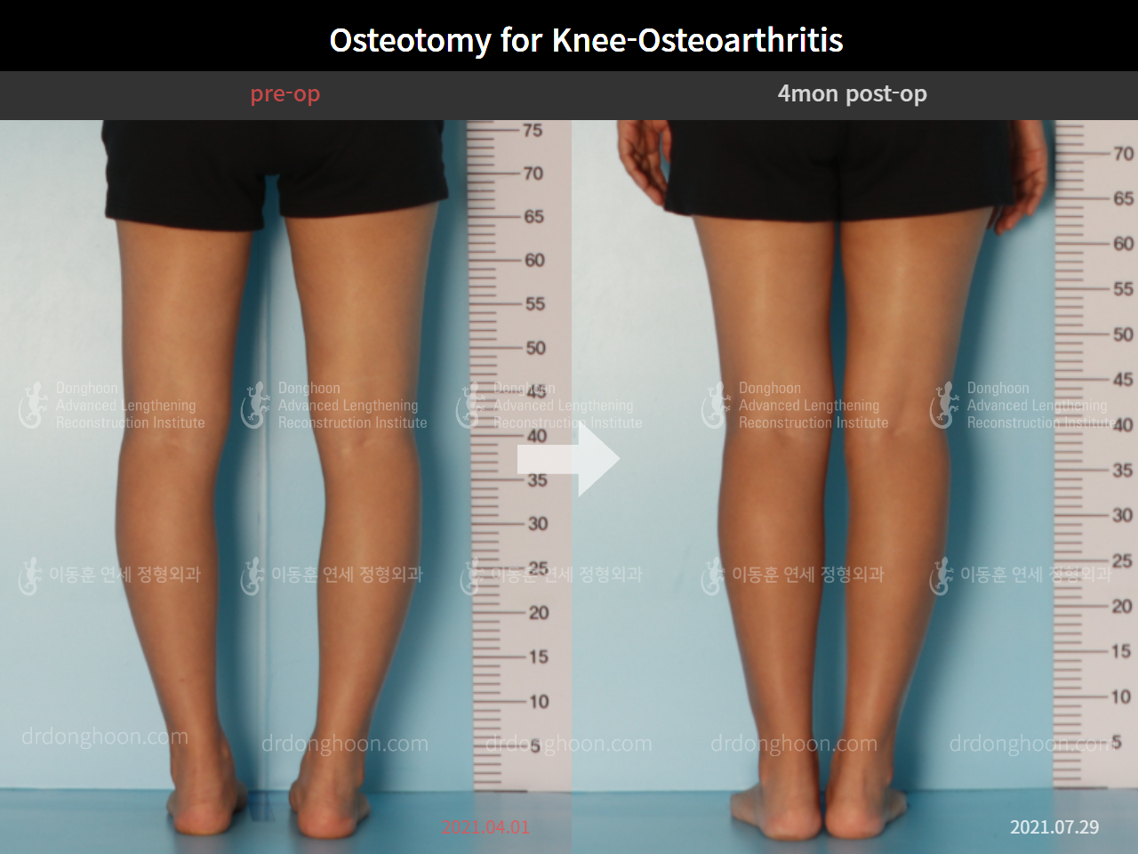 Before and after osteotomy for knee osteoarthritis, case 9075421, image 4, Dr. Donghoon institute (DALRI)