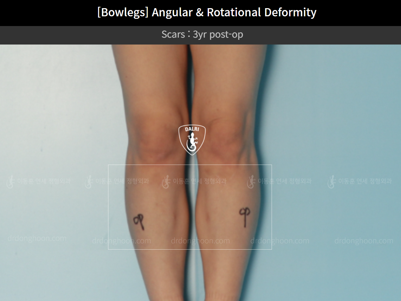 Before and after adult bowlegs, case 9678047, image 4, Dr. Donghoon institute (DALRI)