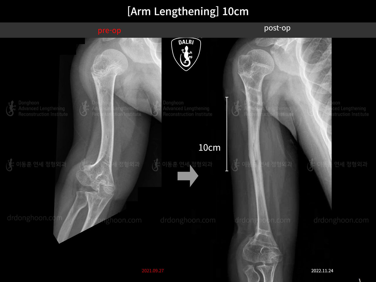 Before and after arm lengthening, case 13536914, image 6, Dr. Donghoon institute (DALRI)
