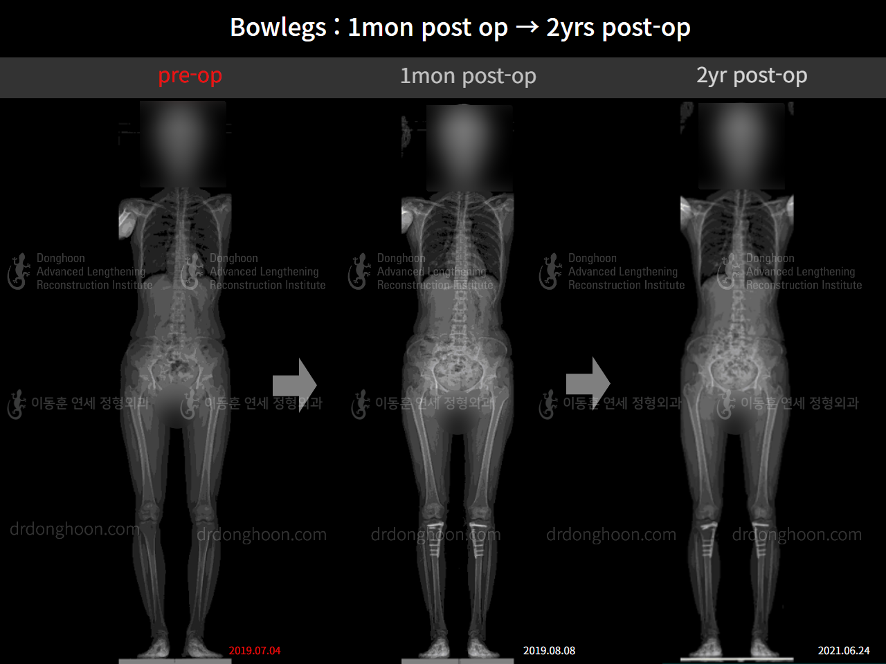 Before and after adult bowlegs, case 10023318, image 10, Dr. Donghoon institute (DALRI)