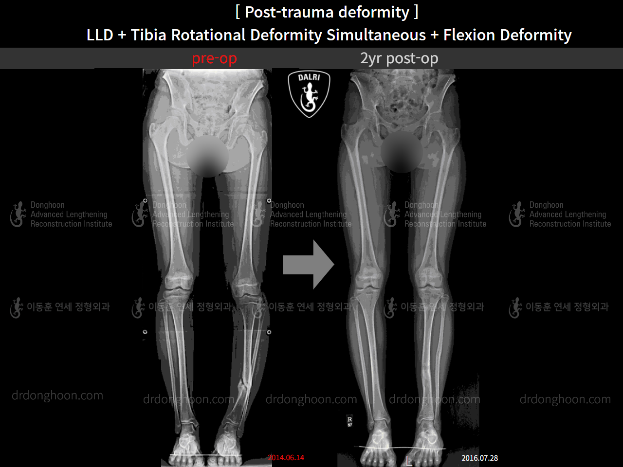 Before and after post-trauma deformity, case 11378676, image 1, Dr. Donghoon institute (DALRI)