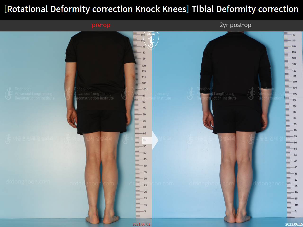 Before and after adult knock knees, case 15524370, image 3, Dr. Donghoon institute (DALRI)