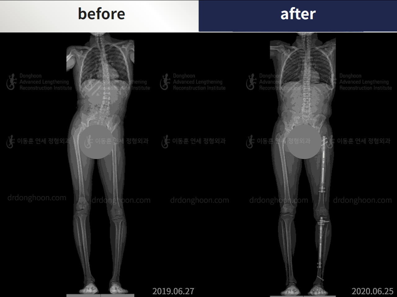 Before and after adult lld, case 5059029, image 3, Dr. Donghoon institute (DALRI)