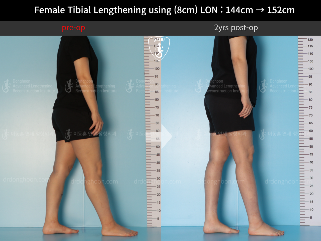 Before and after cll lon, case 12855676, image 3, Dr. Donghoon institute (DALRI)