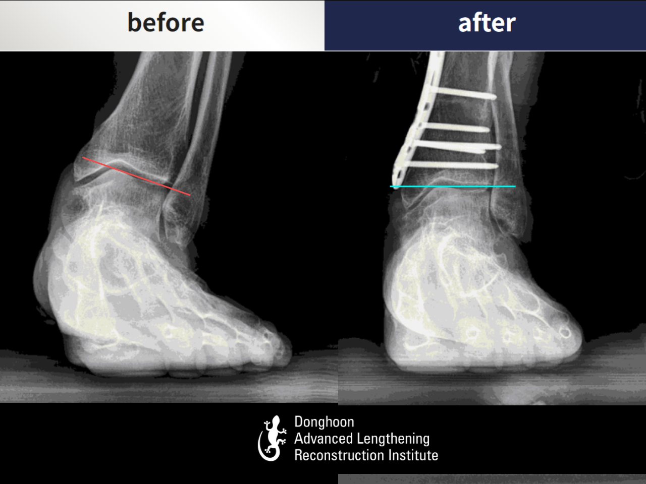 Before and after foot & ankle deformity, case 5204403, image 2, Dr. Donghoon institute (DALRI)