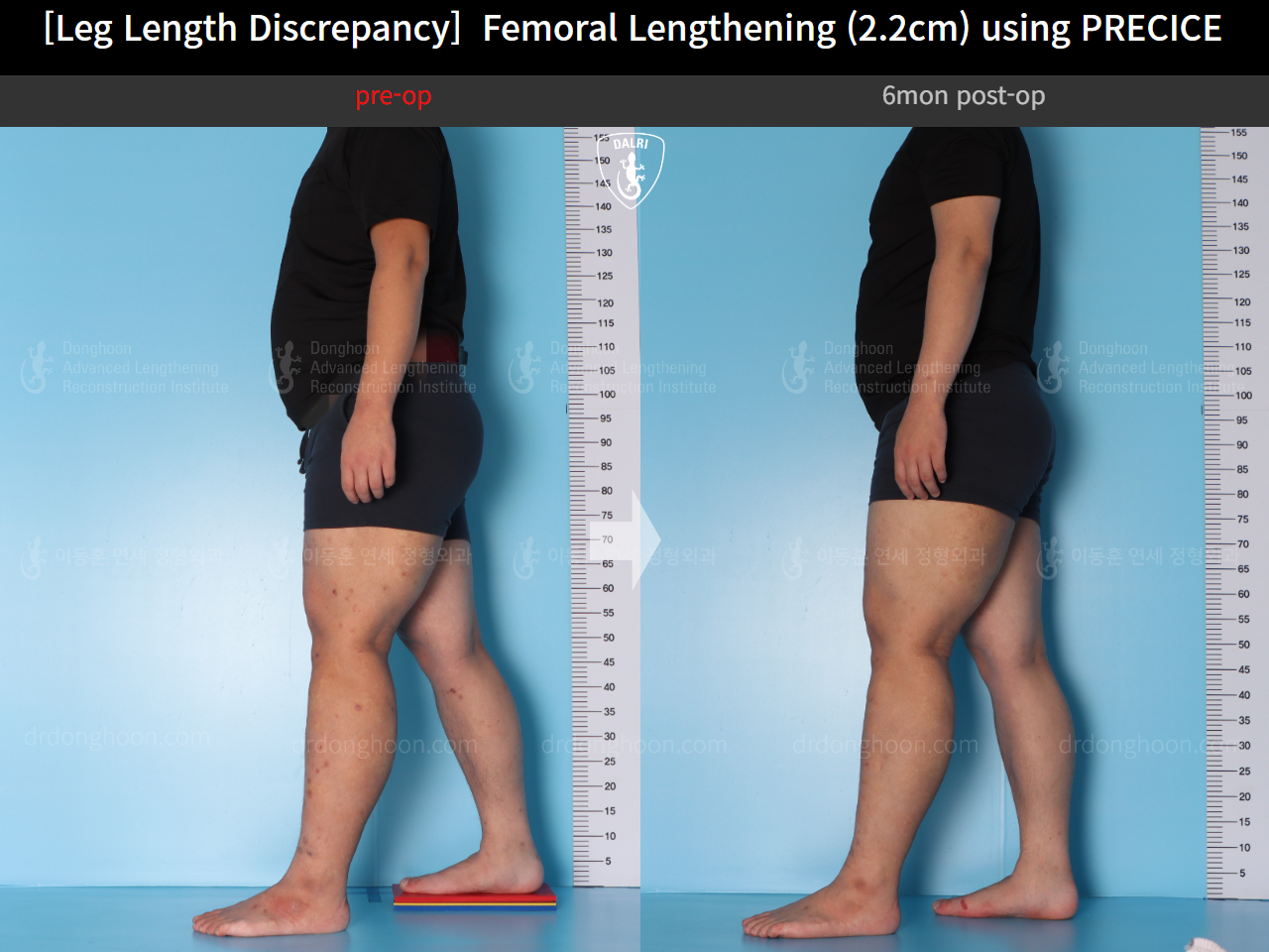 Before and after adult lld, case 15416698, image 4, Dr. Donghoon institute (DALRI)