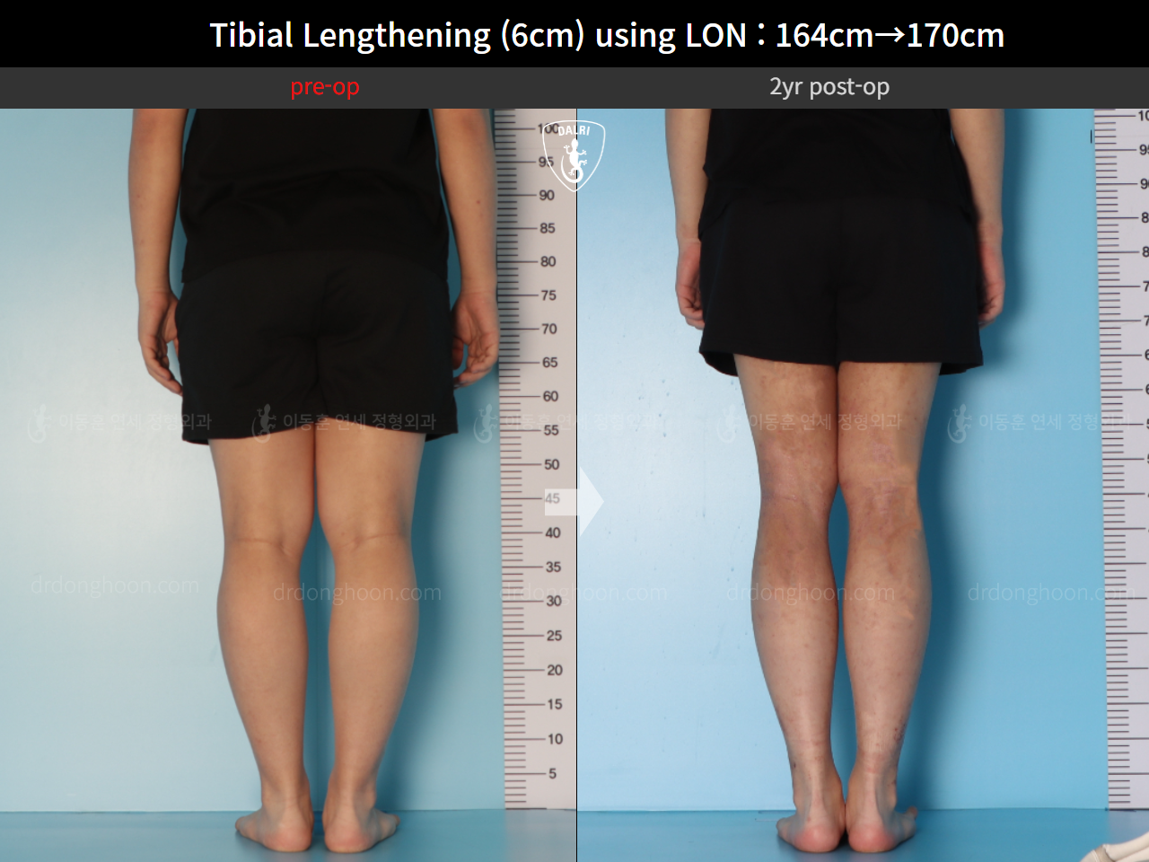 Before and after cll lon, case 15706217, image 4, Dr. Donghoon institute (DALRI)