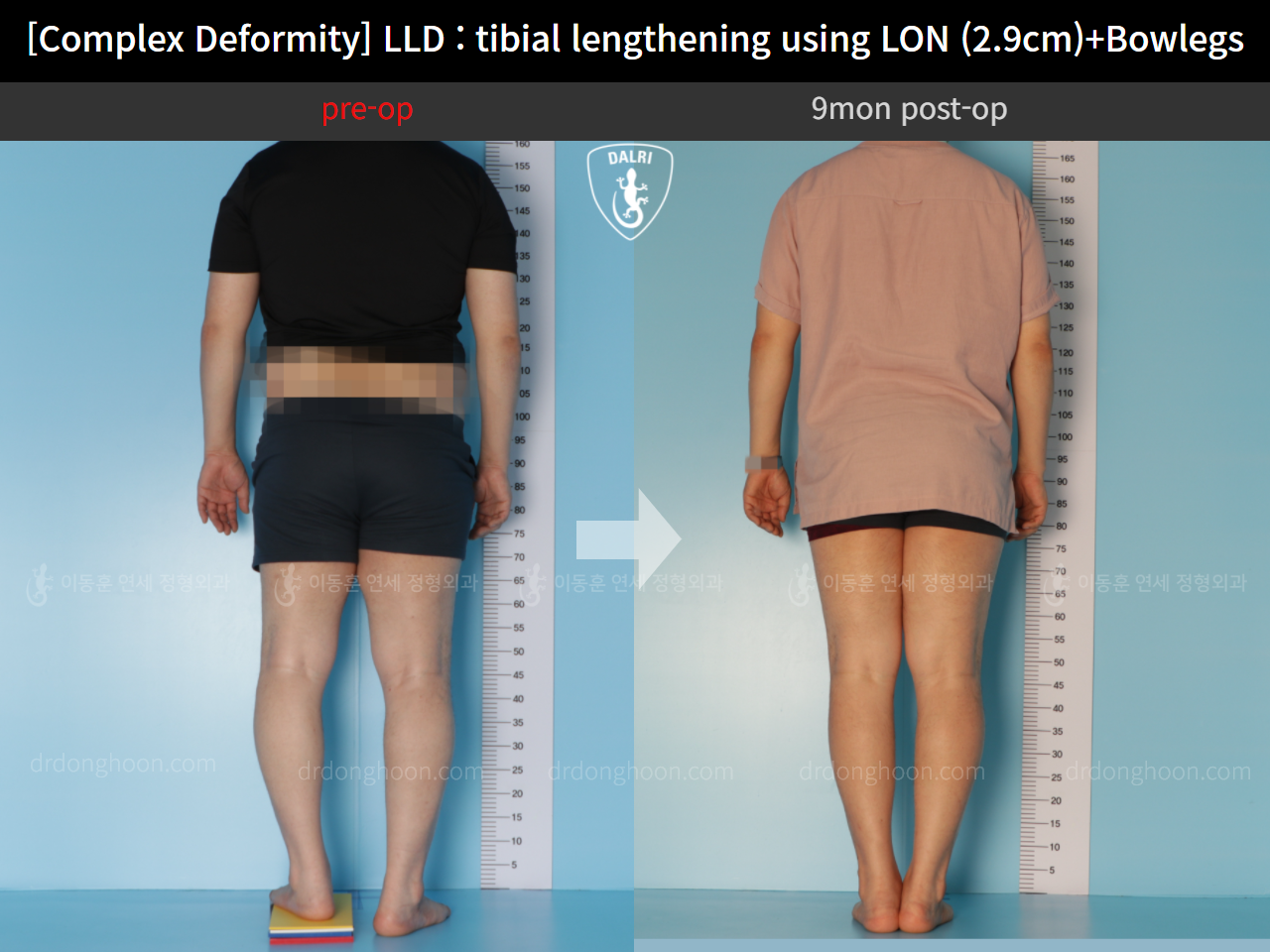 Before and after complex deformity, case 11233983, image 2, Dr. Donghoon institute (DALRI)