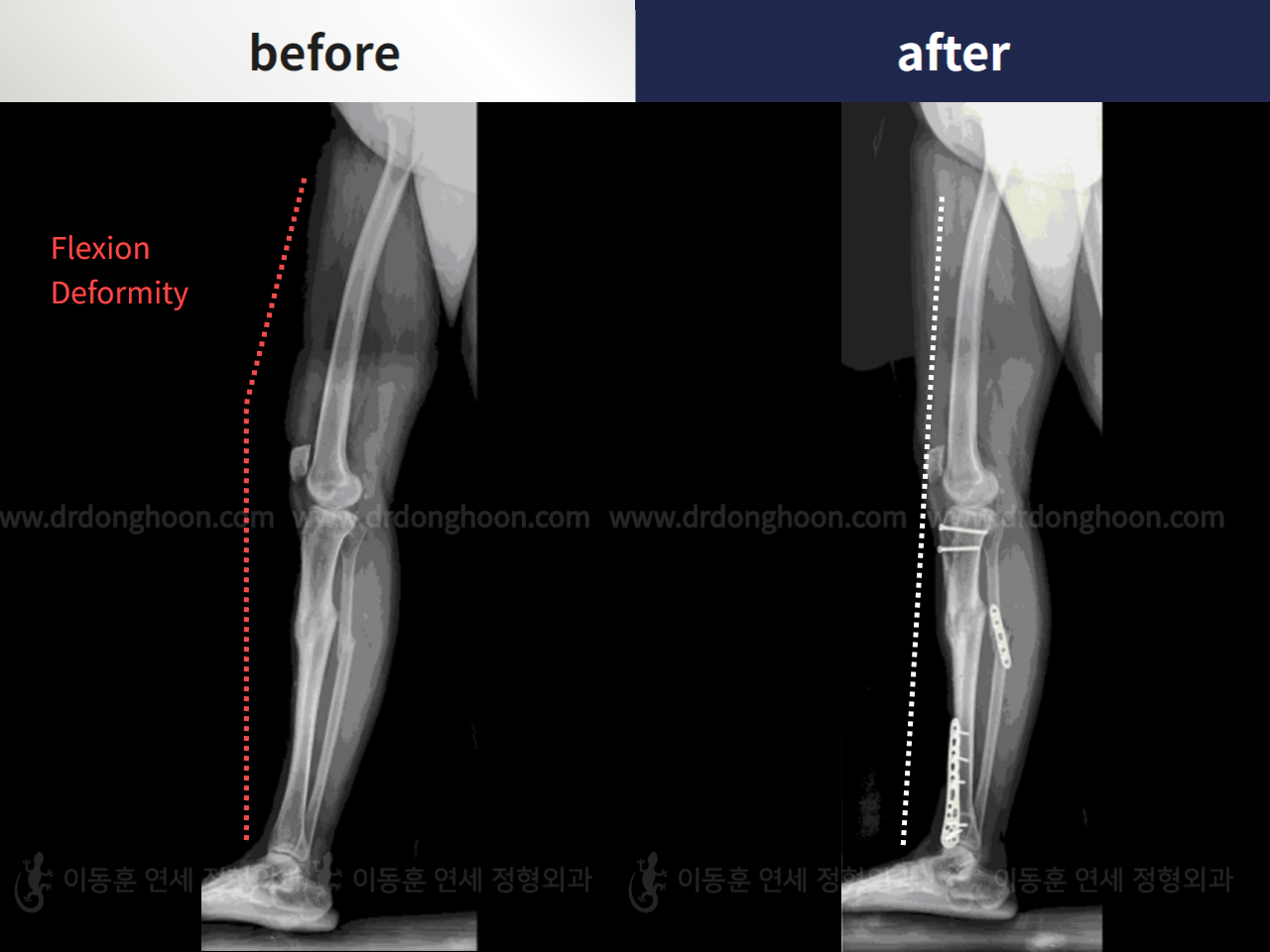 Before and after osteotomy for knee osteoarthritis, case 6011366, image 3, Dr. Donghoon institute (DALRI)