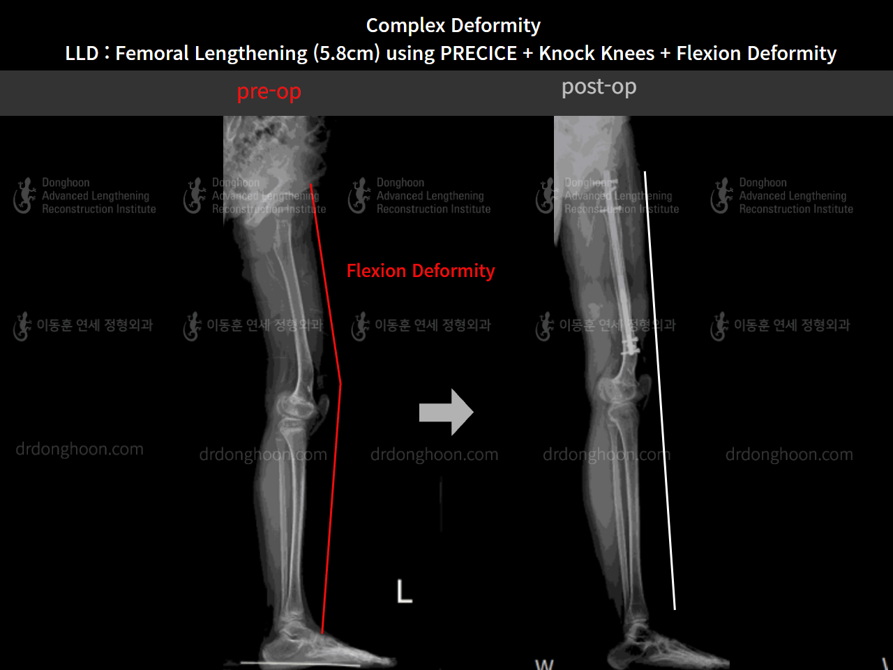 Before and after complex deformity, case 8790512, image 6, Dr. Donghoon institute (DALRI)