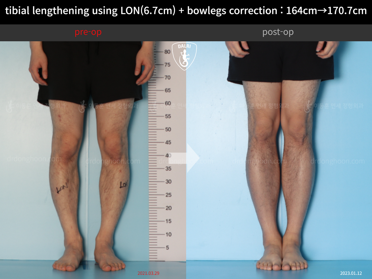 Before and after cll + deformity correction, case 13914972, image 7, Dr. Donghoon institute (DALRI)