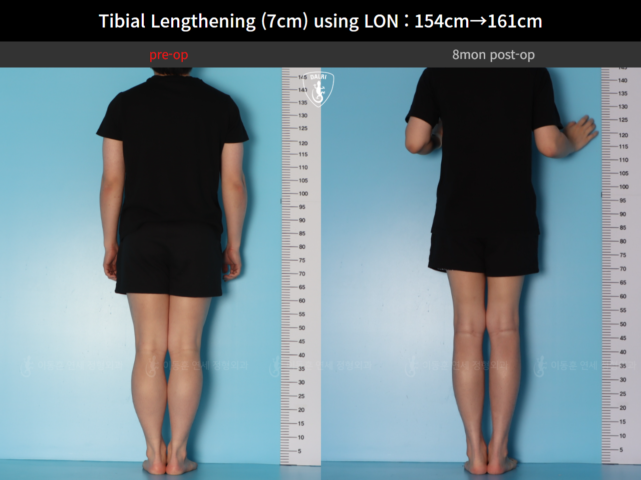 Before and after cll lon, case 127519935, image 3, Dr. Donghoon institute (DALRI)