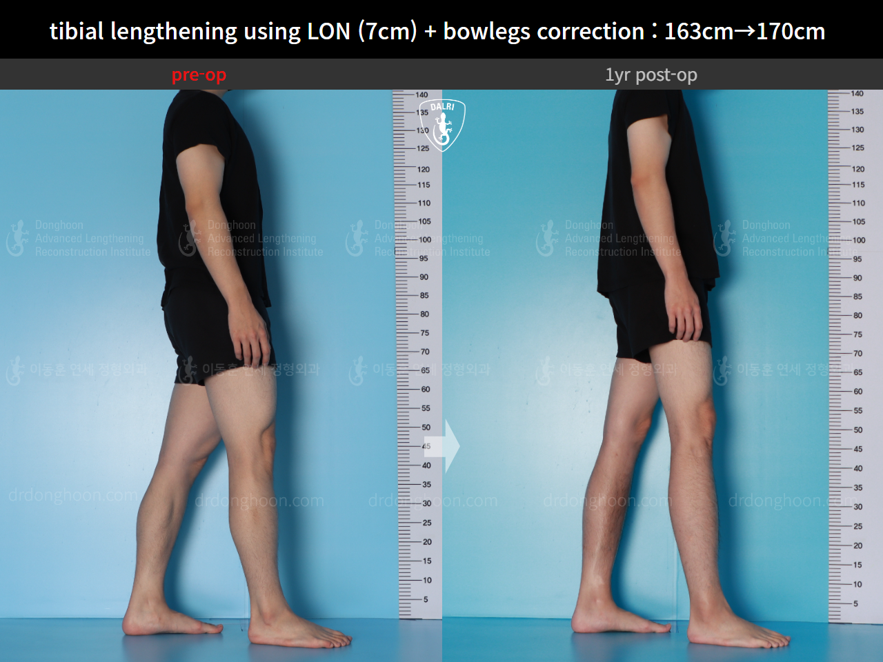 Before and after cll lon, case 16131902, image 7, Dr. Donghoon institute (DALRI)