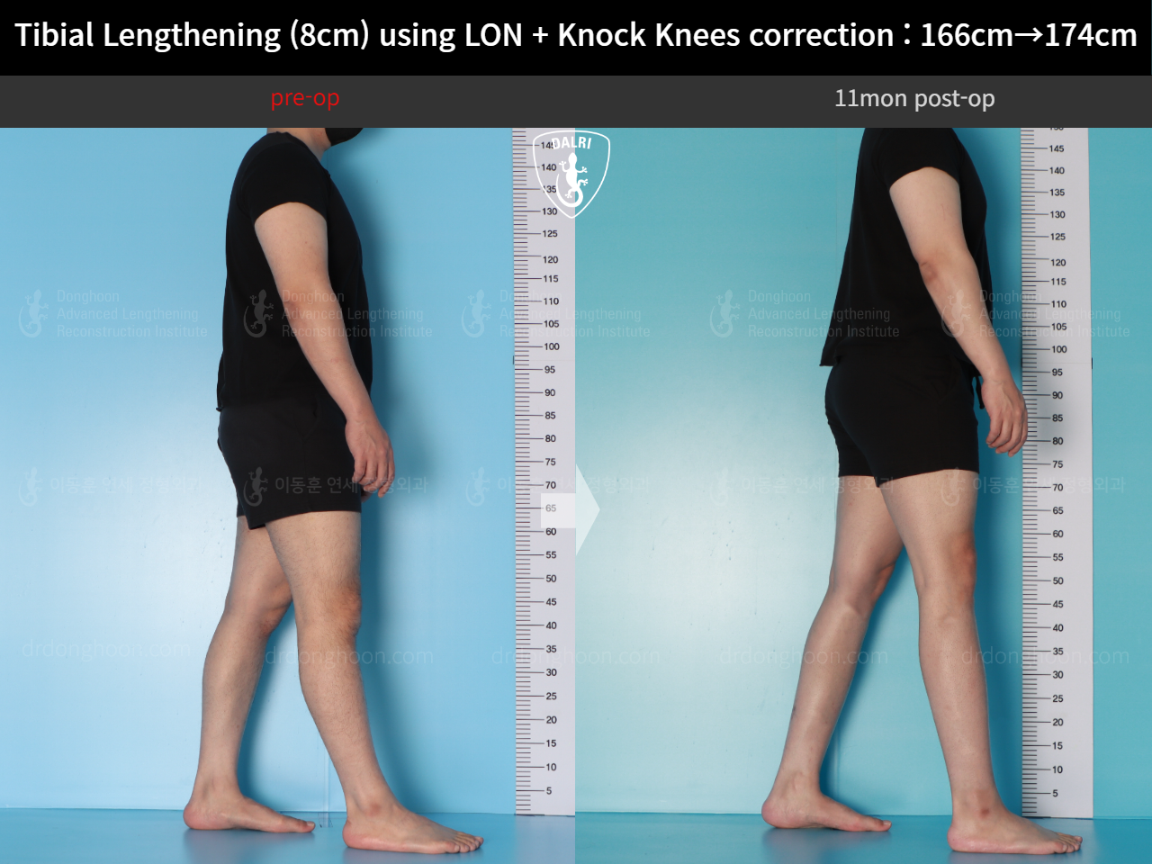 Before and after cll + deformity correction, case 20789954, image 3, Dr. Donghoon institute (DALRI)