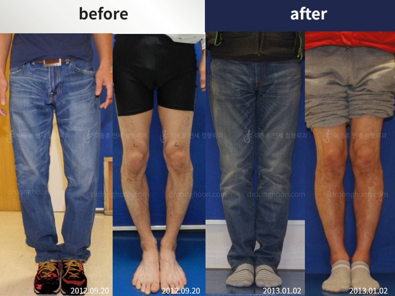 Before and after adult bowlegs, case 4311126, image 3, Dr. Donghoon institute (DALRI)