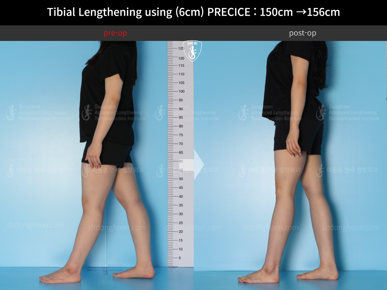 Before and after cll precice, case 14065180, image 4, Dr. Donghoon institute (DALRI)