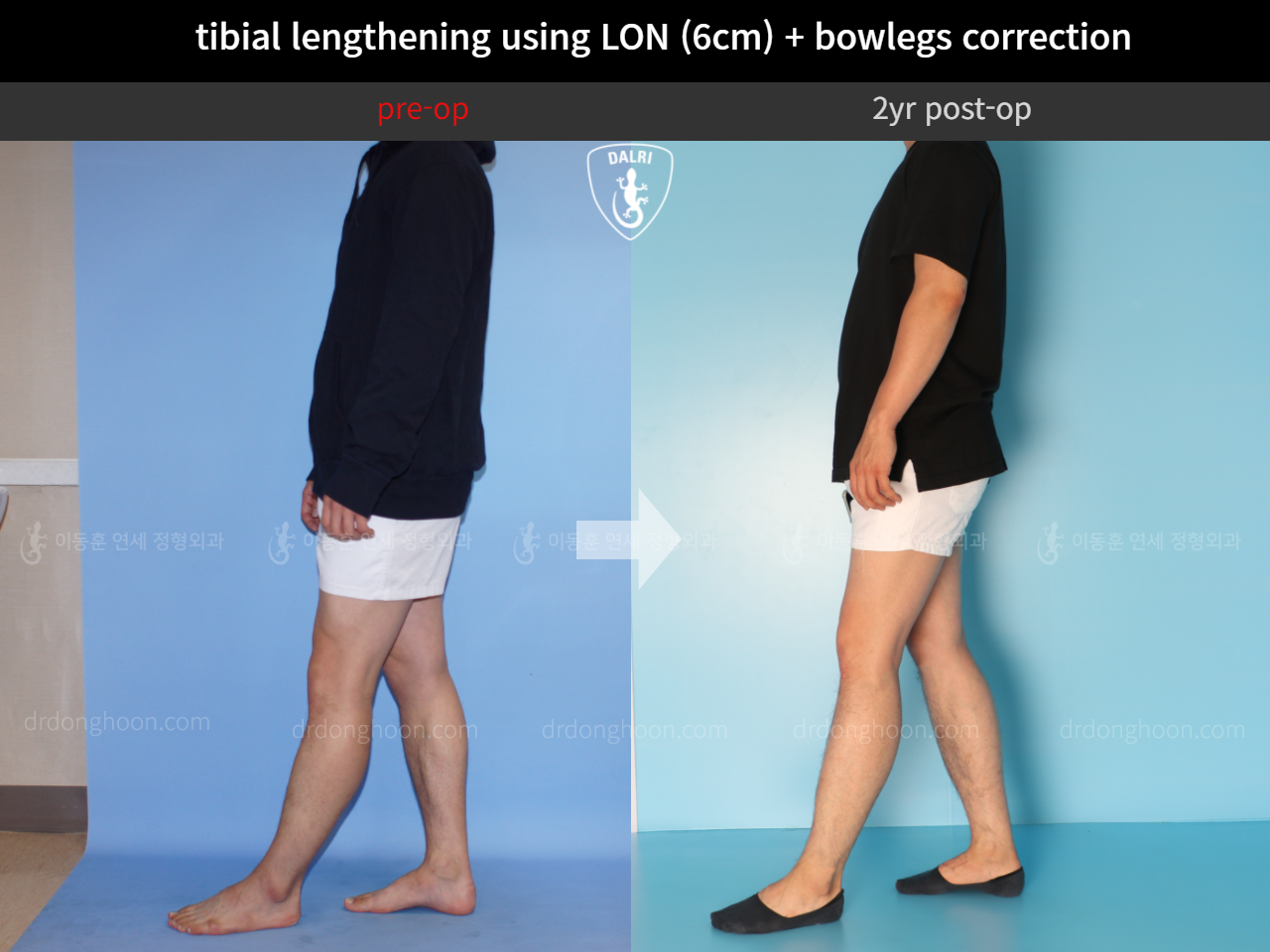 Before and after cll + deformity correction, case 4323155, image 3, Dr. Donghoon institute (DALRI)