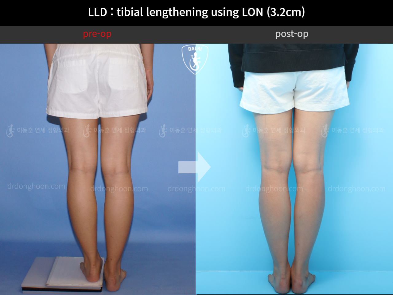 Before and after adult lld, case 4320309, image 5, Dr. Donghoon institute (DALRI)