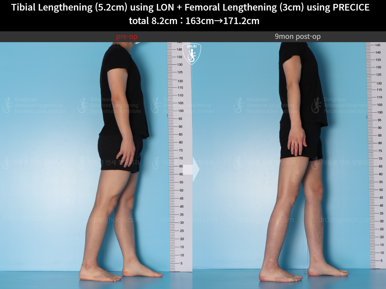 Before and after cll precice, case 15203330, image 7, Dr. Donghoon institute (DALRI)