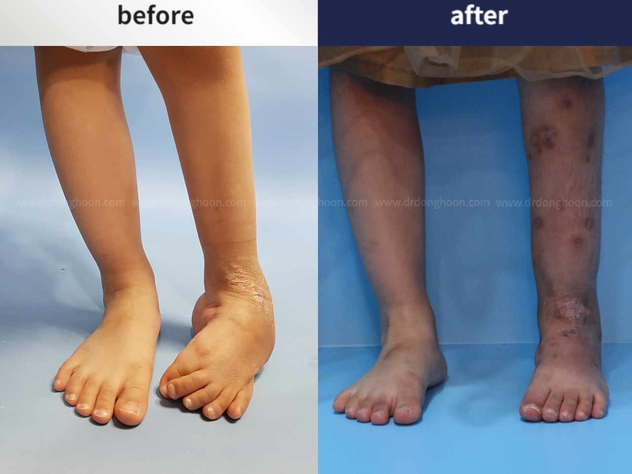 Before and after paediatric congenital condition, case 4304763, image 1, Dr. Donghoon institute (DALRI)