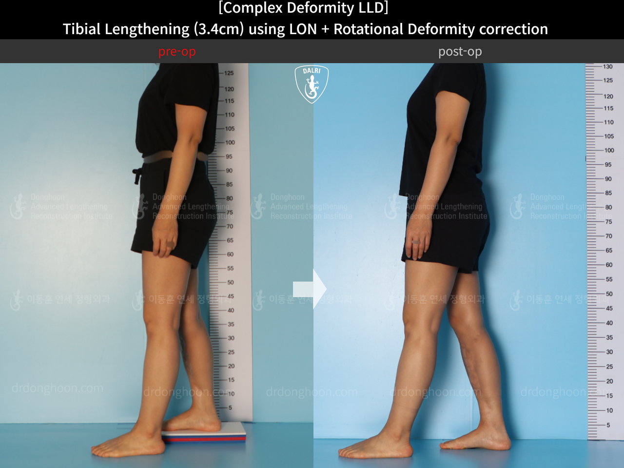 Before and after adult lld, case 14350311, image 6, Dr. Donghoon institute (DALRI)