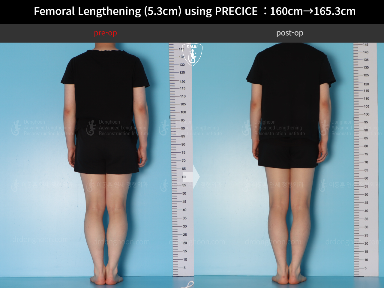 Before and after cll precice, case 18250566, image 2, Dr. Donghoon institute (DALRI)