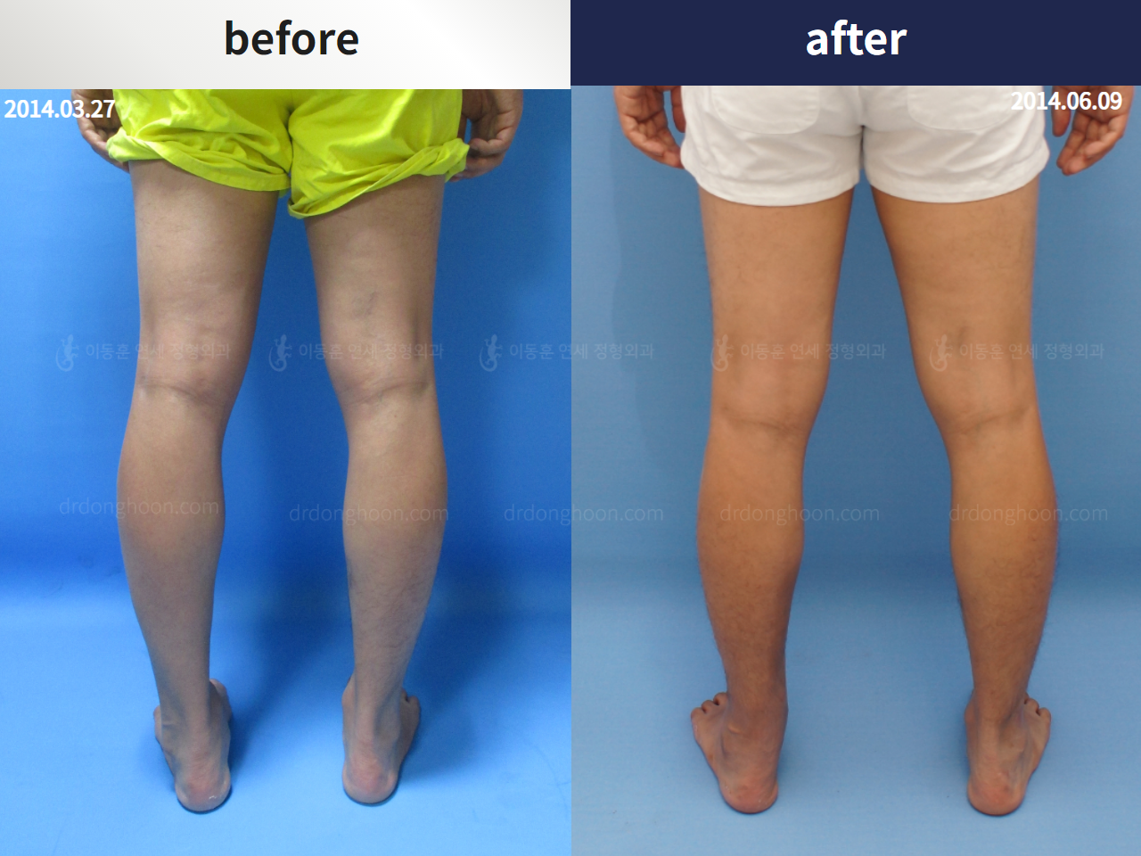 Before and after foot & ankle deformity, case 4246372, image 4, Dr. Donghoon institute (DALRI)