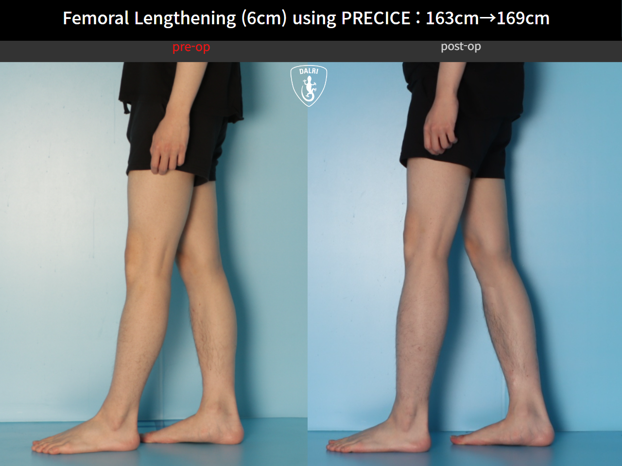 Before and after cll precice, case 33545760, image 8, Dr. Donghoon institute (DALRI)
