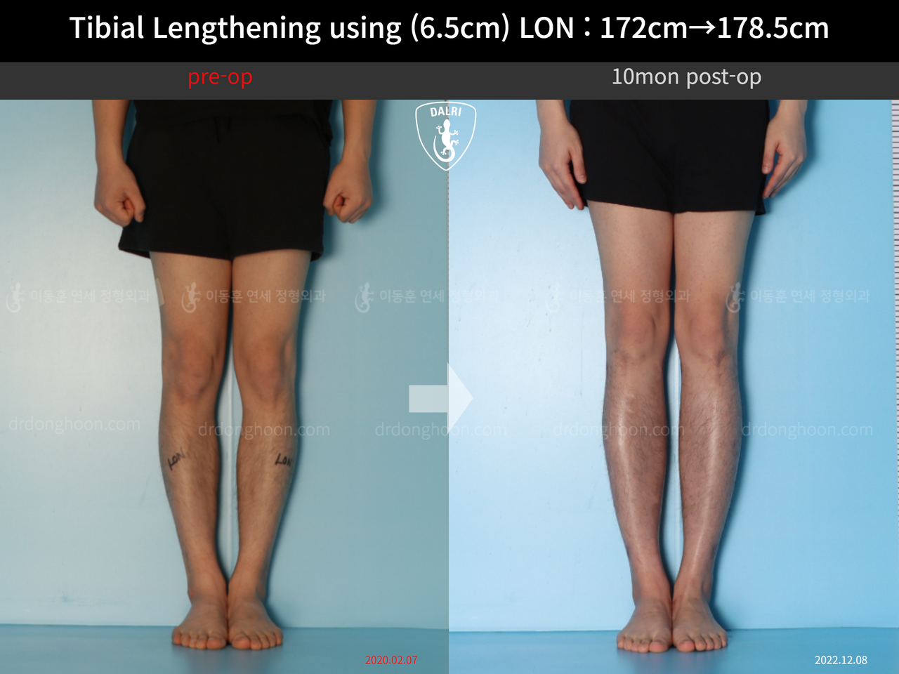 Before and after cll lon, case 13642628, image 4, Dr. Donghoon institute (DALRI)