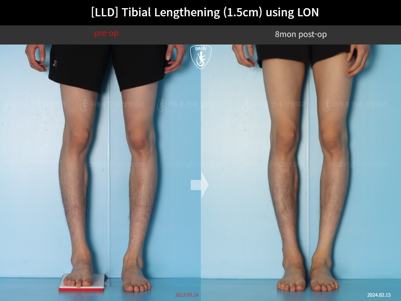Before and after adult lld, case 18244334, image 5, Dr. Donghoon institute (DALRI)