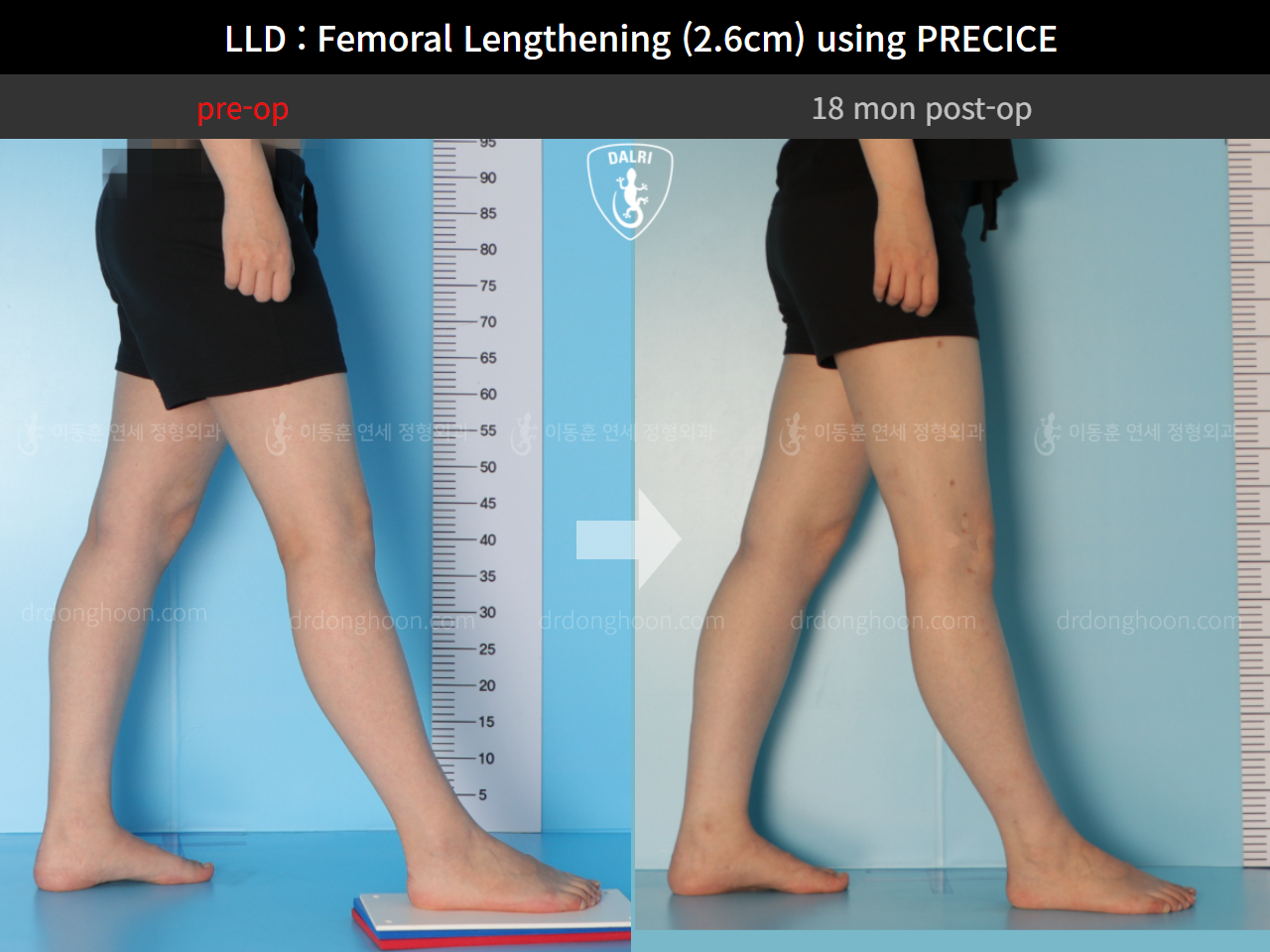 Before and after adult lld, case 9332755, image 6, Dr. Donghoon institute (DALRI)