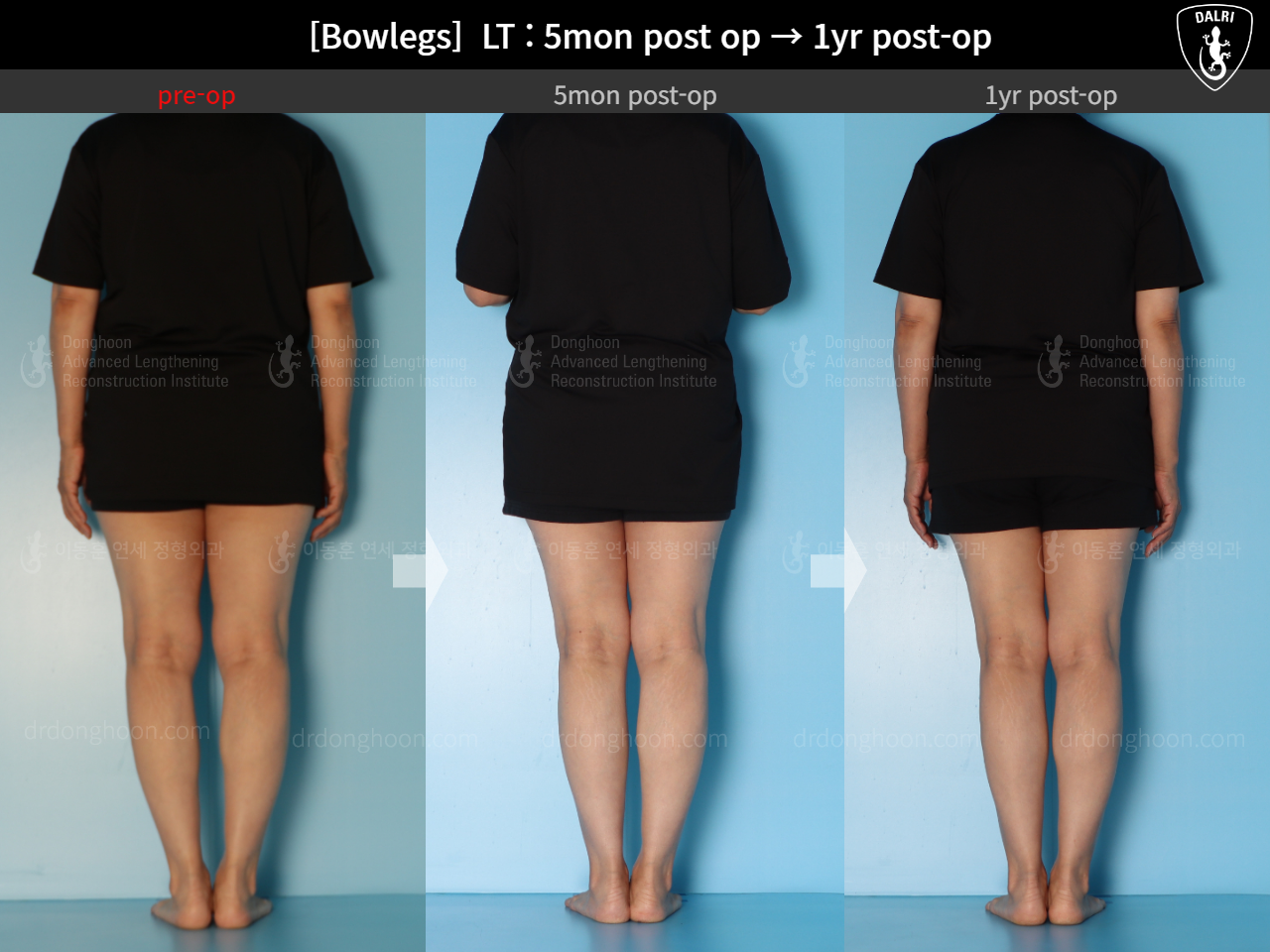 Before and after adult bowlegs, case 15172734, image 4, Dr. Donghoon institute (DALRI)
