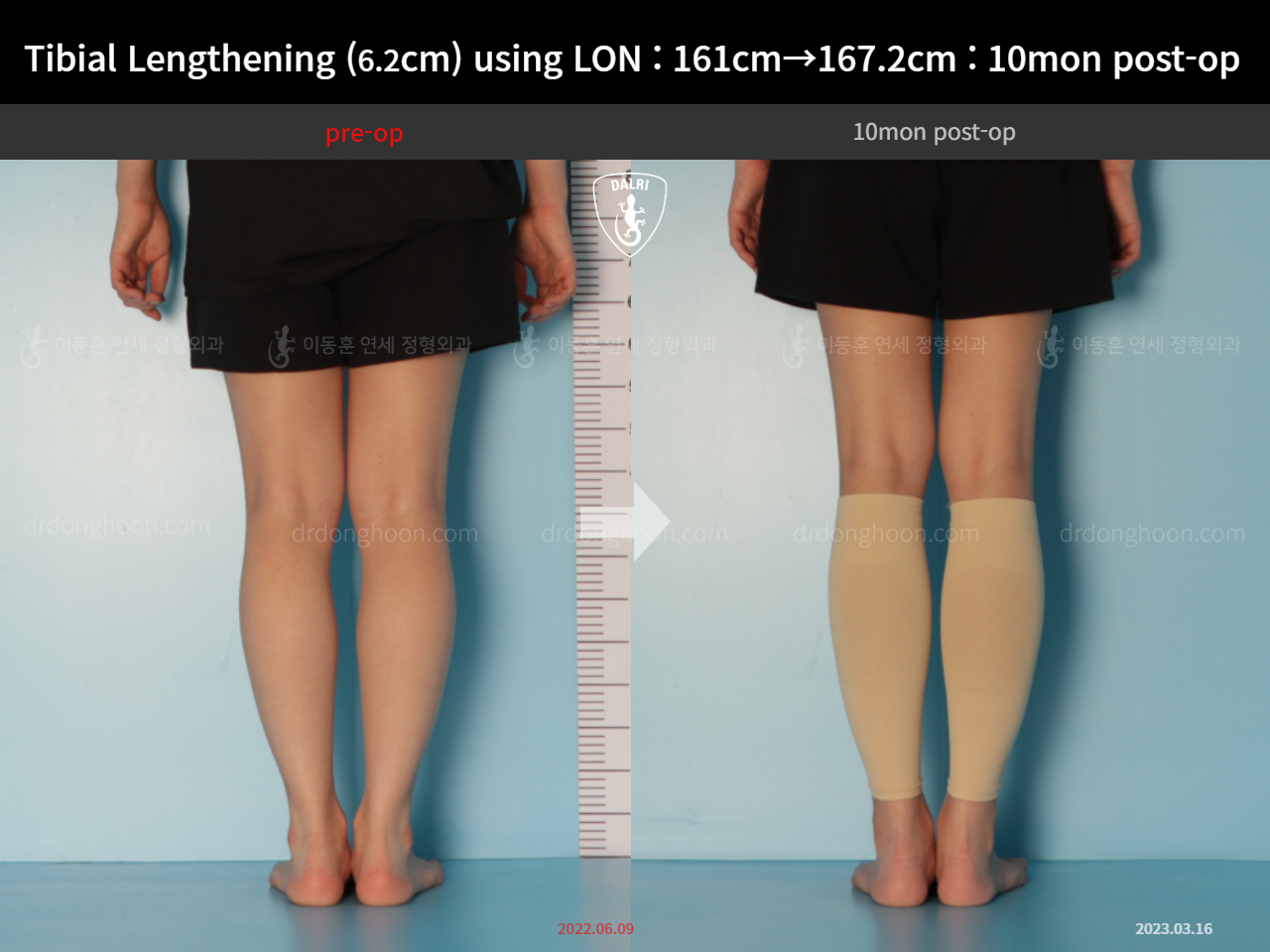 Before and after cll lon, case 14502141, image 6, Dr. Donghoon institute (DALRI)