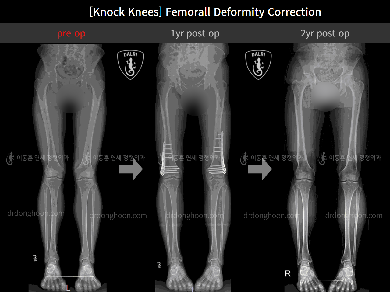 Before and after adult knock knees, case 4310847, image 6, Dr. Donghoon institute (DALRI)