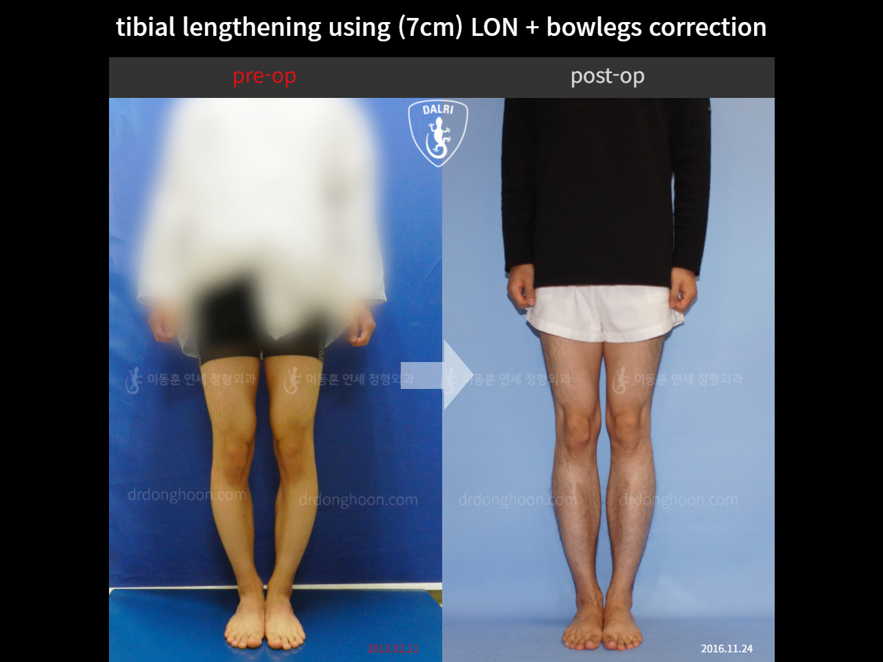 Before and after cll + deformity correction, case 4323143, image 1, Dr. Donghoon institute (DALRI)