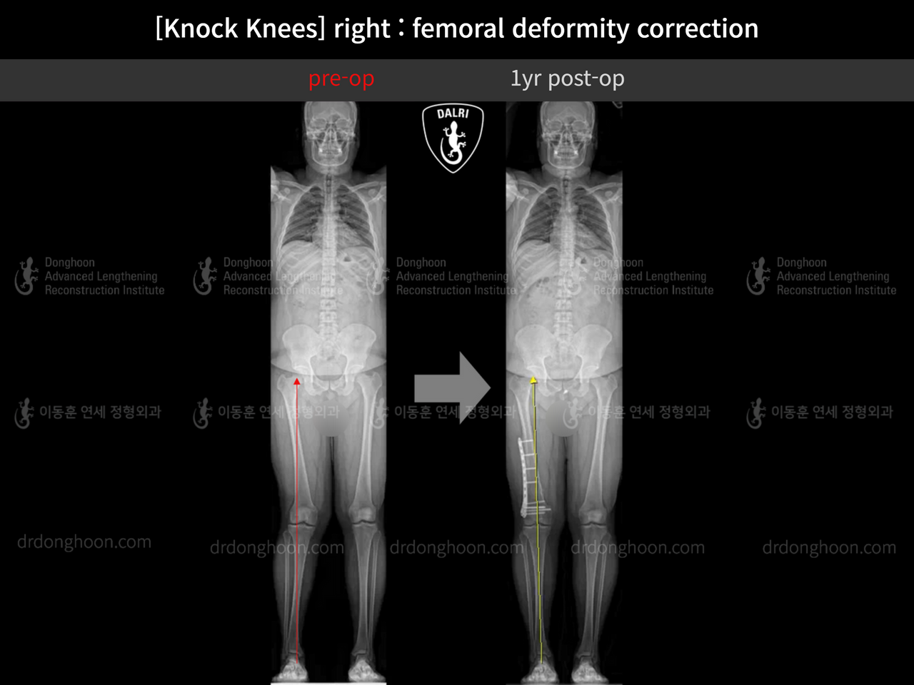 Before and after adult knock knees, case 13582115, image 6, Dr. Donghoon institute (DALRI)