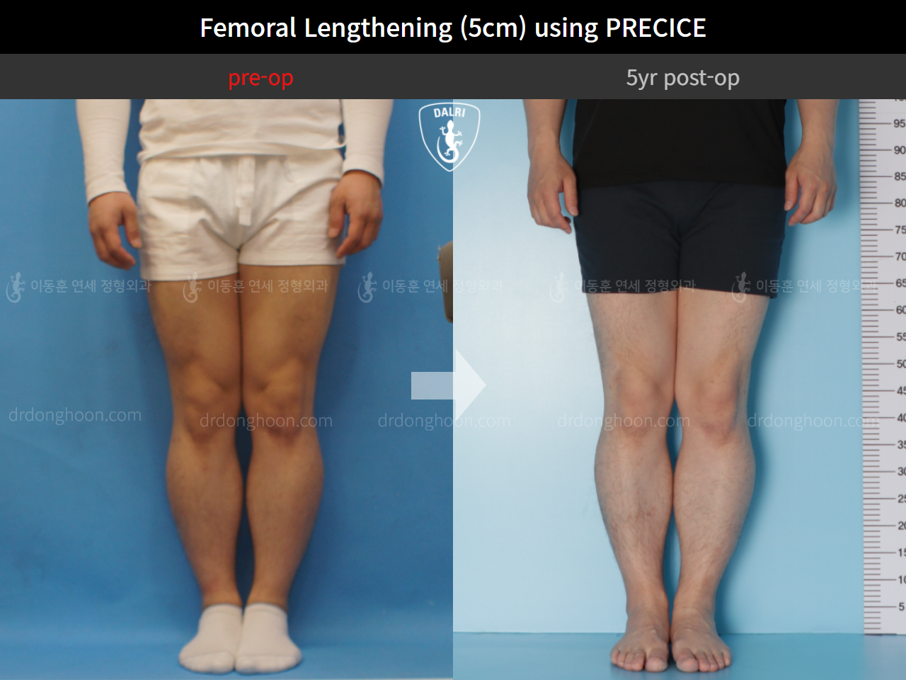 Before and after cll precice, case 4573586, image 3, Dr. Donghoon institute (DALRI)