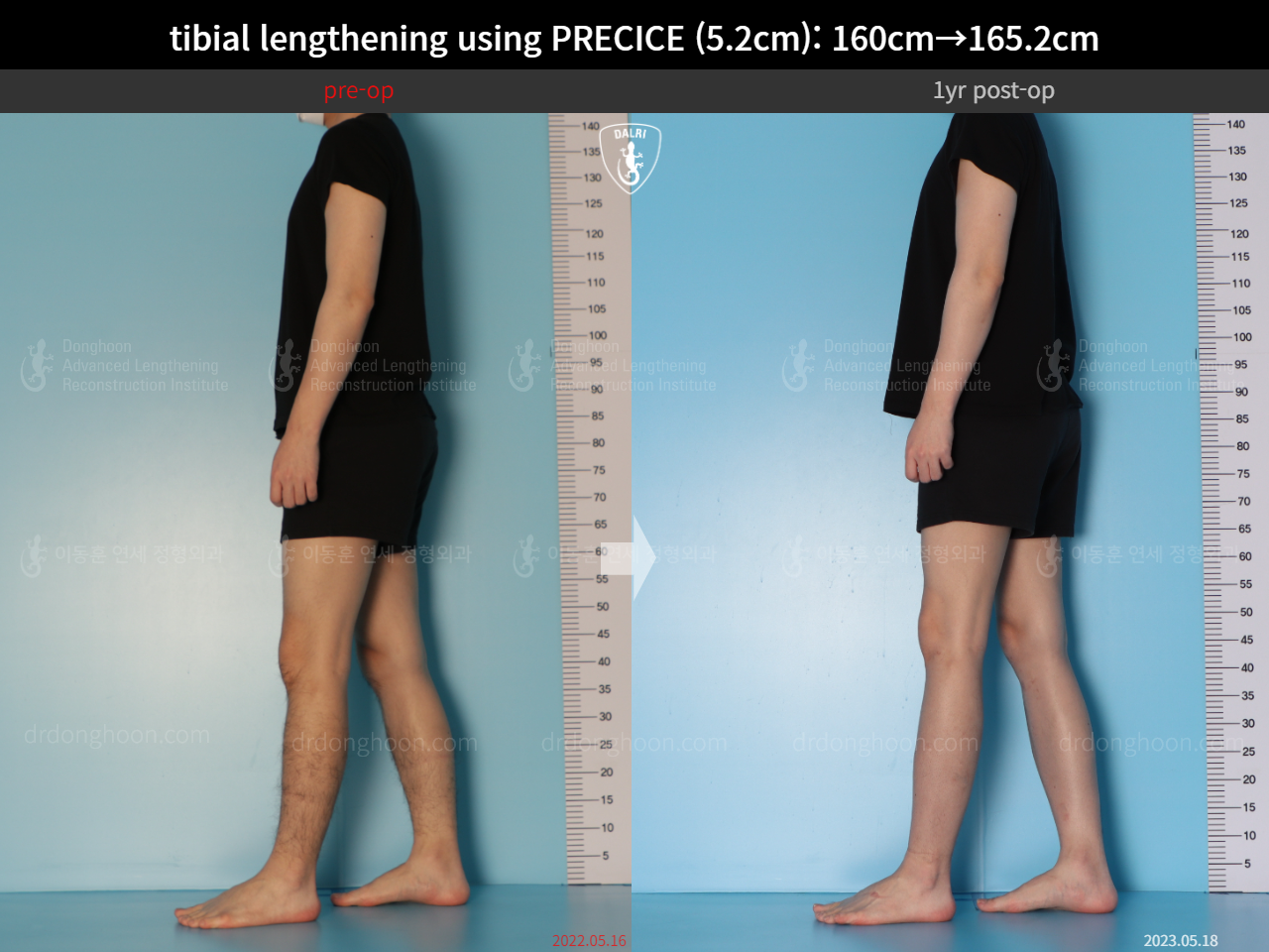 Before and after cll precice, case 15213098, image 8, Dr. Donghoon institute (DALRI)