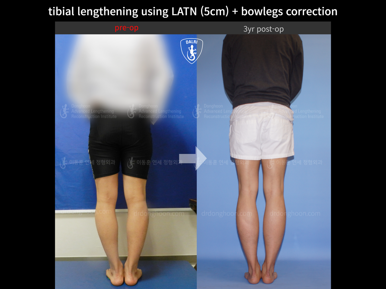 Before and after cll + deformity correction, case 13476494, image 5, Dr. Donghoon institute (DALRI)