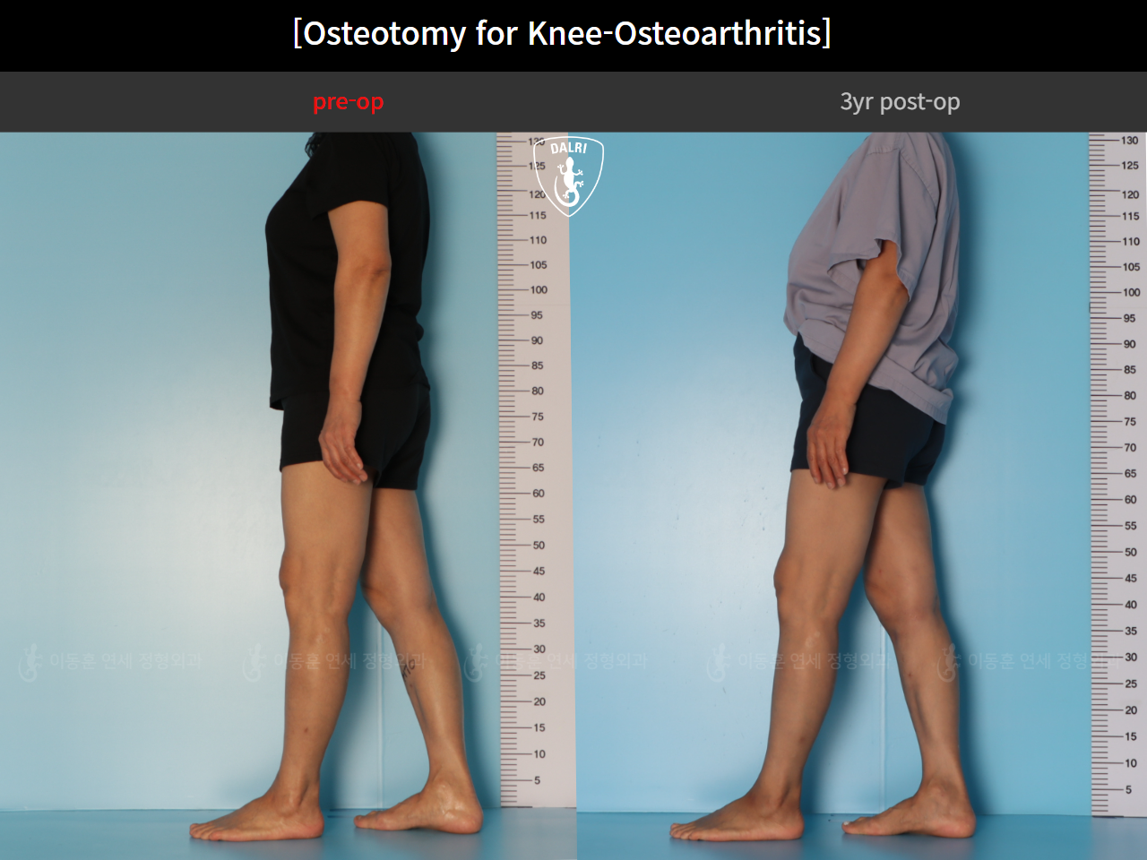 Before and after osteotomy for knee osteoarthritis, case 85842641, image 6, Dr. Donghoon institute (DALRI)
