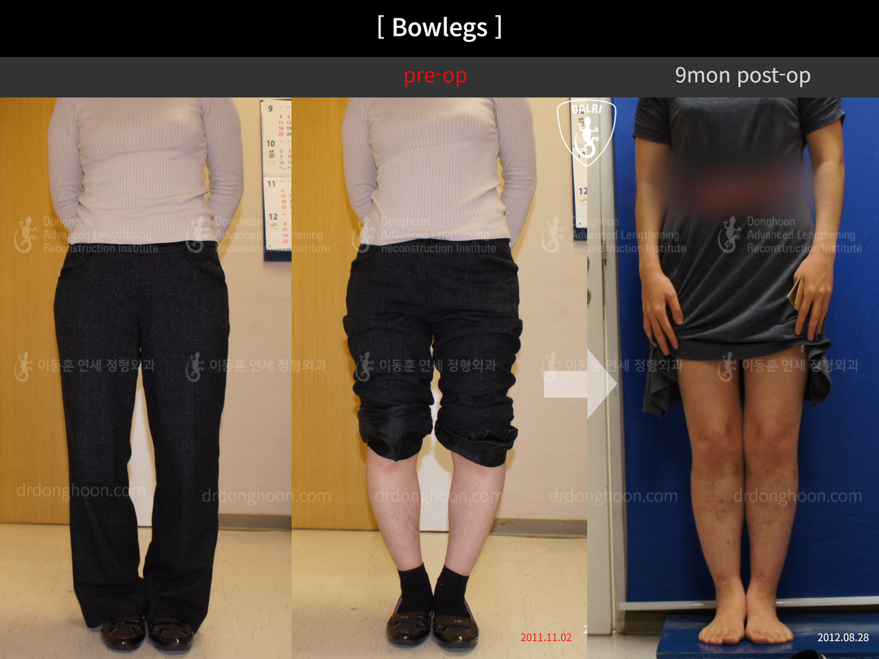 Before and after adult bowlegs, case 12756570, image 1, Dr. Donghoon institute (DALRI)