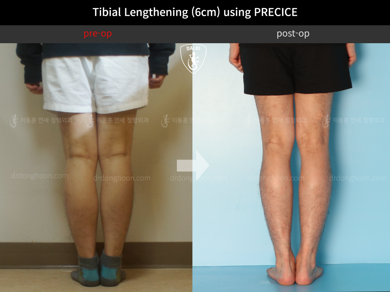 Before and after cll precice, case 11882006, image 4, Dr. Donghoon institute (DALRI)