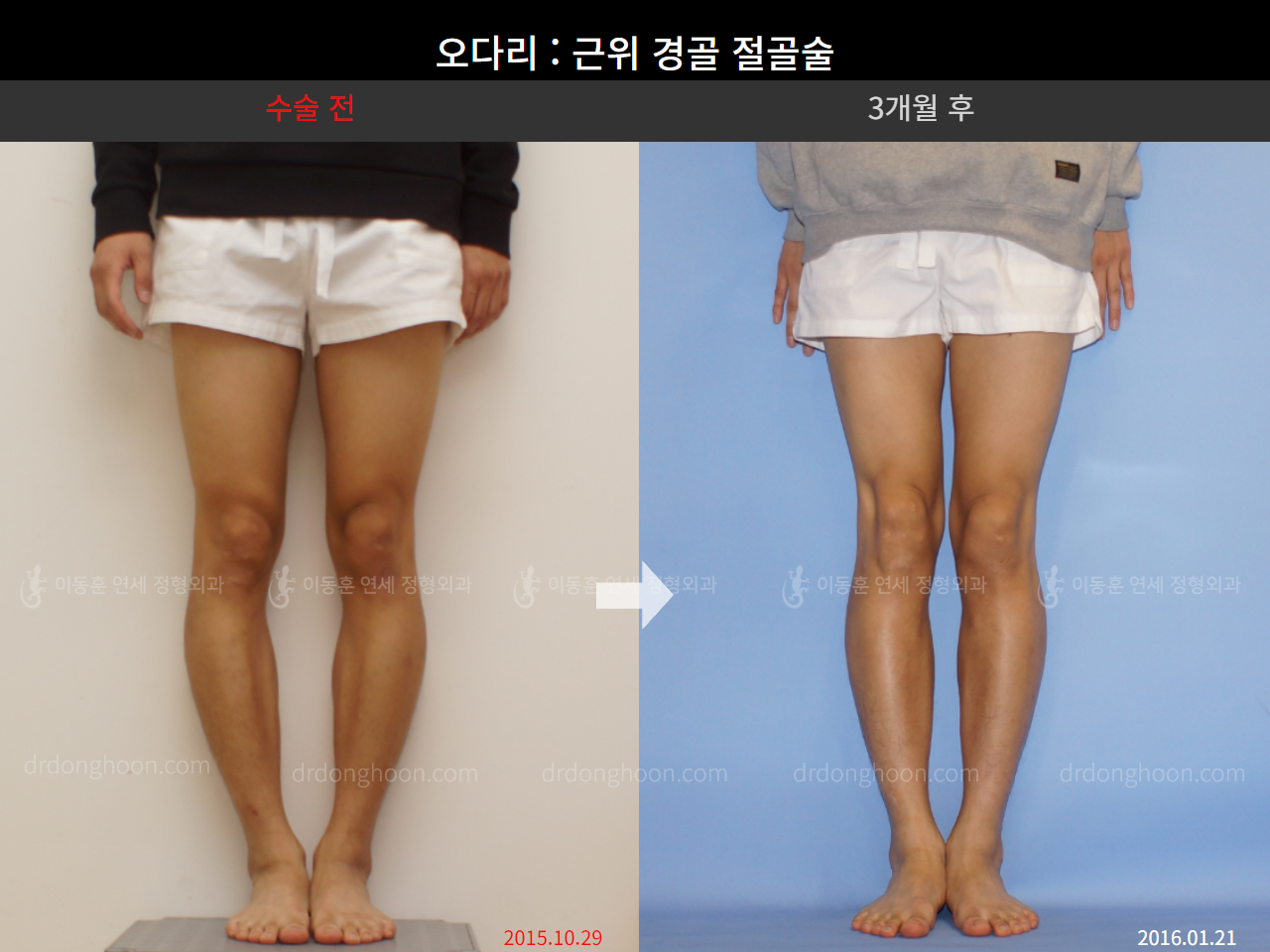 Before and after adult bowlegs, case 4311351, image 3, Dr. Donghoon institute (DALRI)